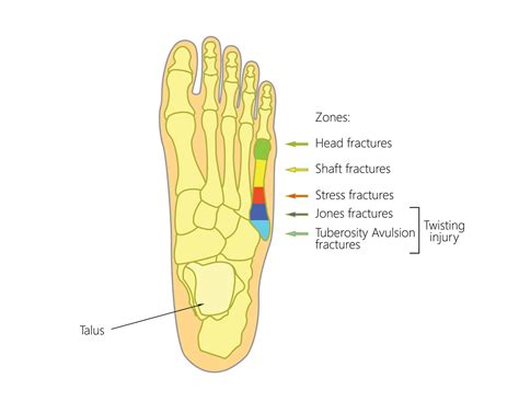 Fifth Metatarsal Fracture Treatment And Tips Metatarsal Fractures