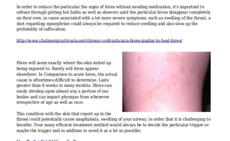 How To Treat Chronic Hives Urticaria 2 Simple Steps Otosection