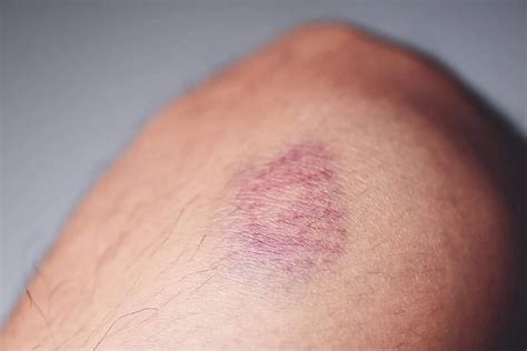 Hematoma Subgaleal O Popular Galo Na Cabeça Aprenda Mais Blog