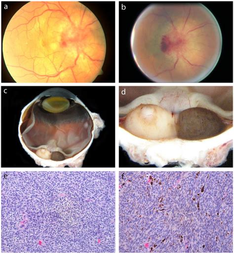 Clinical And Pathological Findings A Initial Dilated Fundus