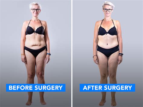 Results App Weight Loss And Excess Skin Removal Surgery