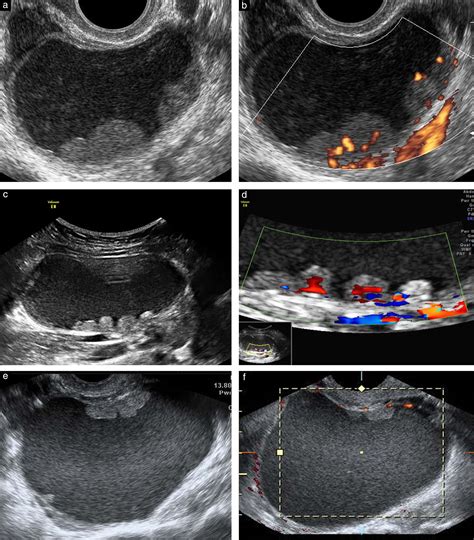 Ovarian Masses With Papillary Projections Diagnosed And Removed During