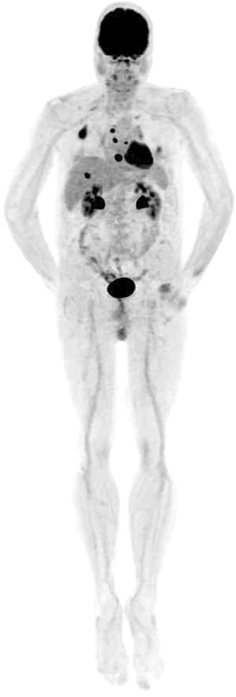 Fdg Pet Image In A Patient With Multiple Myeloma Lesions Are Visible