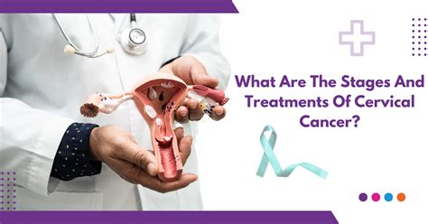 What Are The Stages And Treatments Of Cervical Cancer Sri
