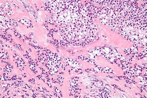 Adenocarcinoma Clear Cell