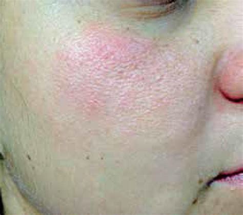 Scielo Brasil Contact Dermatitis To Methylisothiazolinone Contact