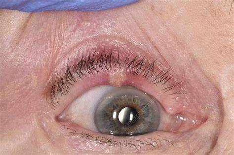 Chalazion Cyst On An Eyelid Stock Image C0472922 Science Photo