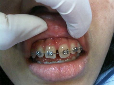 Schön Dental Frenectomy Frenuloplasty Frenotomy Frenulectomy