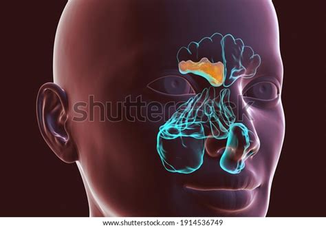 Sinusitis Inflammation Paranasal Cavities 3d Illustration Stock