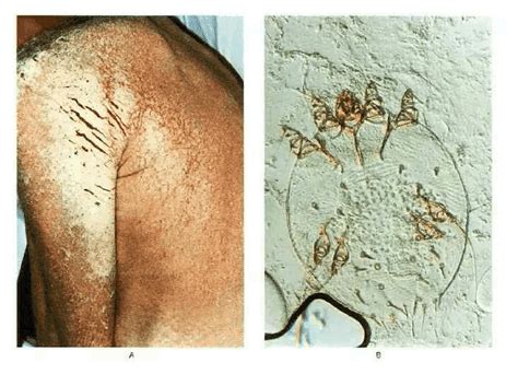 Norwegian Scabies In A Patient With Aids Nejm