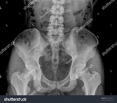 Xray Image Male Pelvis Osteoporosis Stock Photo 272839916 Shutterstock