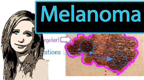 Malignant Melanoma How To Detect Melanoma Early ABCDE Rule Types Of Melanoma YouTube