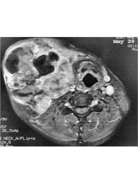 Adenoid Cystic Carcinoma Of Submandibular Gland Case Report
