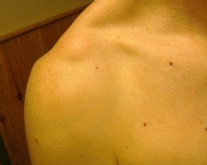 Other causes of pain due to. Hard, Soft, Painful Lump on Shoulder, Under Skin, Muscle ...