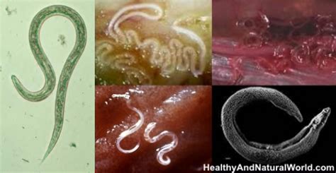 Top 14 Foods And Herbs That Naturally Kill Intestinal Parasites