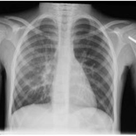 Chest X Ray Demonstrating Hyperlucency Confirming Swyer James Macleod