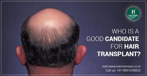 Who Is A Good Candidate For Hair Transplant