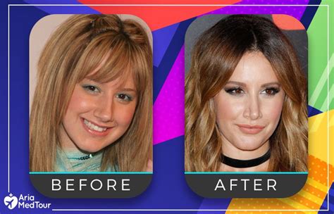 Ashley Tisdale Nose Job Before And After