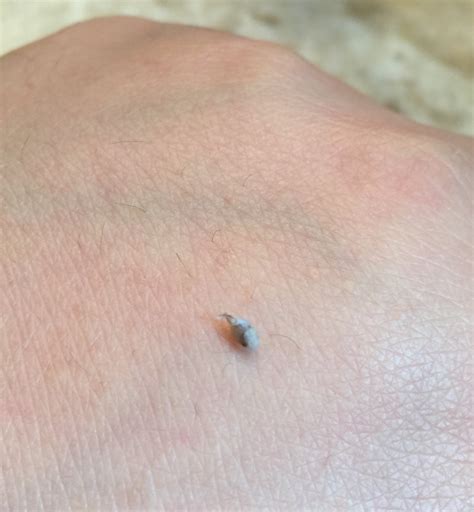 Sometimes, a cyst can develop. Saw a bump on my armpit and pressed on it, this came out ...