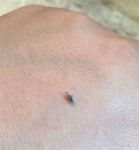 What does ingrown hair mean? Saw a bump on my armpit and pressed on it, this came out ...