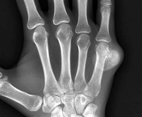 Fifth Metacarpal Fracture Fracture Treatment