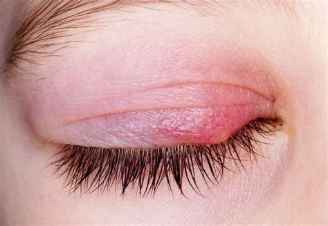 The 5 Most Common Eye Infections And How To Avoid Them Focus Clinics