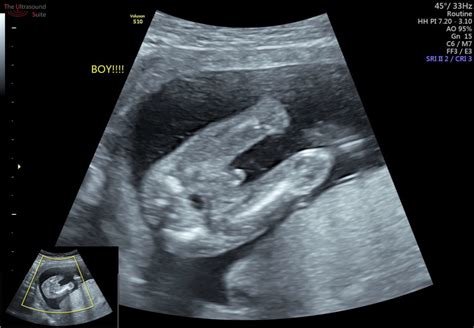 How Early Can I Find Out My Baby S Gender The Ultrasound Suitethe Ultrasound Suite