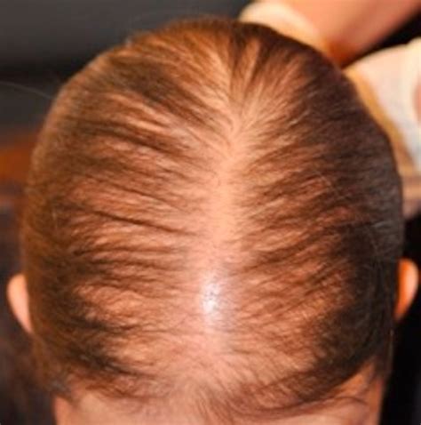 Hair Loss Anaemia Is Receding Hairline Caused By Female Pattern Hair