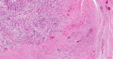Pathology Outlines Smooth Muscle Tumors Of Uncertain Malignant Potential