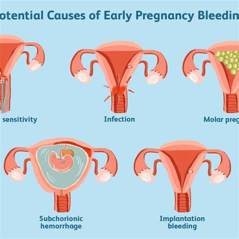 Light Brown Discharge Early Pregnancy Brown Discharge During