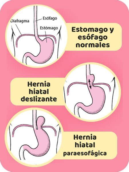 Hernia Hiatal ¿qué Es Síntomas Tratamiento Tipos