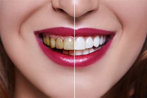 How Long Do Veneers Last Hint It Depends On The Material