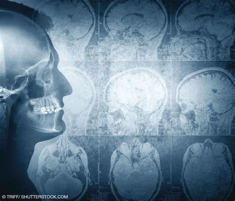 Neuropsychiatry: Toward Solving the Mysteries That Animate Psychiatry | Psychiatric Times