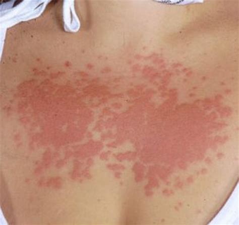 Sun Rash Pictures Medical Pictures And Images 2021 Updated