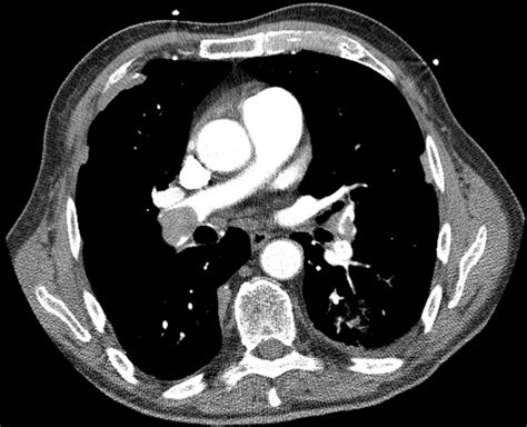 Thorax Ct Scan