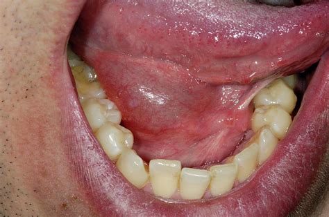 Swollen Sublingual Salivary Gland Photograph By Dr P Marazziscience