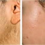 Laser Hair Removal First Treatment Results Pictures
