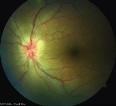 Blurred Margins Hyperemia And Swelling Of The Optic Disc Download