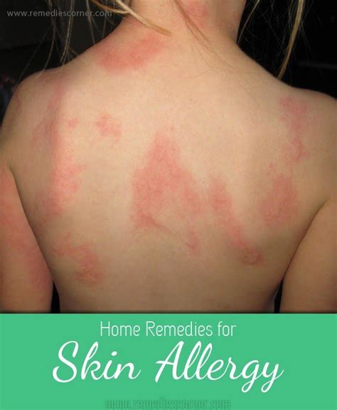 What natural home remedies treat an allergic what tests diagnose food allergies? Home remedies for skin allergy | Home remedies for skin ...