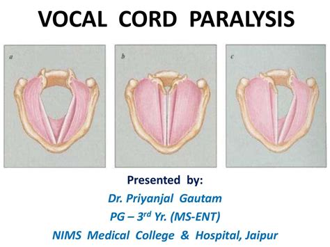 Vocal Cord Paralysis Paralysis Vocal Cord