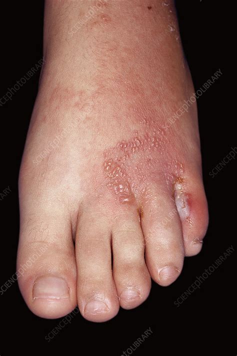 Fungal Infection And Eczema Of The Foot Stock Image C0509821