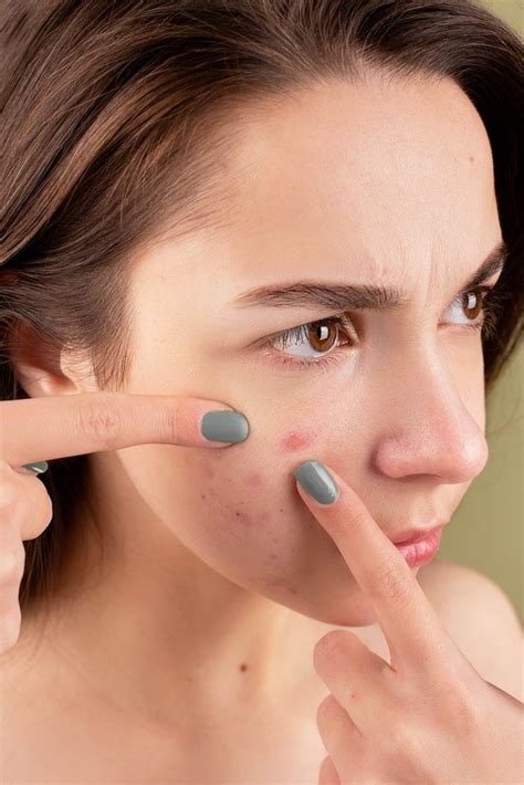 Understanding Adult Acne Beauty Buzz Beauty World News