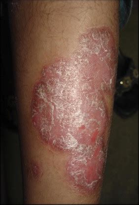 Comorbidity means more than one disease or condition is present in the same person at the same time. Comorbidities in Patients with Psoriasis - The American ...