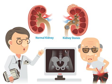 Passing A Kidney Stone How Long It Takes Best Health Magazine