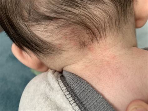 Red Spots On The Back Of Neck May 2019 Birth Club Babycenter Canada