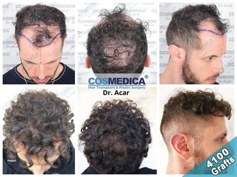 Greffe De Cheveux Turquie 98 De Taux De Réussite Dr Acar