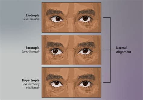 Strabismus Crossed Eyes Esotropia Extropia Hypertropia Treatment