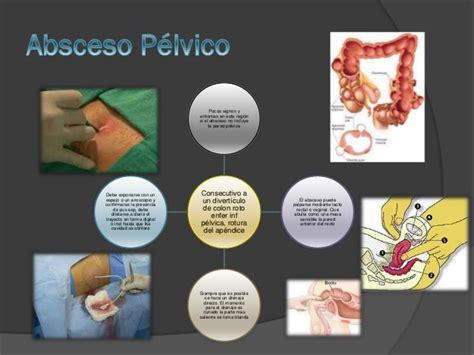 Abscesos