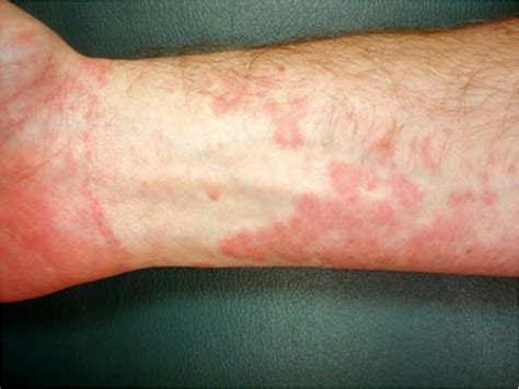 Erythema Multiforme Recognition And Management Aafp