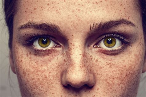 Mole And Freckle Removal Costs Options And At Home Treatments
